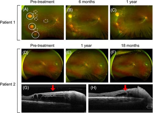 Pediatric patients with von Hippel–Lindau and hemangioblastomas treated successfully with belzutifan