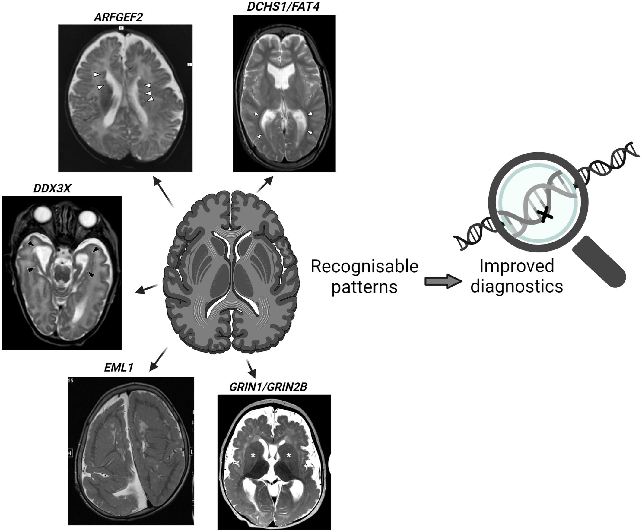 Recognisable Neuroradiological Findings in Five Neurogenetic Disorders