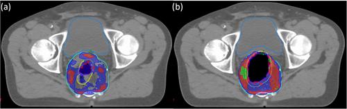 Dosimetric impact of variable air cavity within PTV for rectum cancer