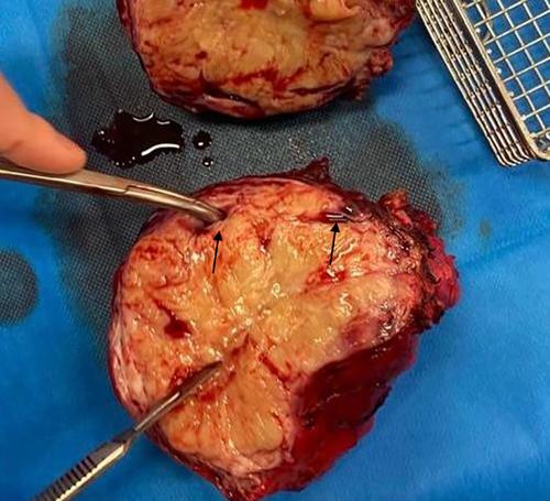 Botulinum toxin type A treatment for a parotid gland injury in two adult horses