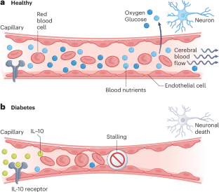 Diabetes, IL-10 and the brain’s microvascular crisis