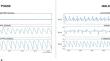 Stress Level Assessment by a Multi-Parametric Wearable Platform: Relevance of Different Physiological Signals