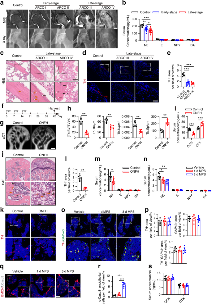 Inhibition of sympathetic tone via hypothalamic descending pathway propagates glucocorticoid-induced endothelial impairment and osteonecrosis of the femoral head