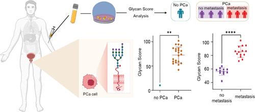 Liquid-Biopsy Glycan Score Biomarker Accurately Indicates and Stratifies Primary and Metastatic Prostate Cancers