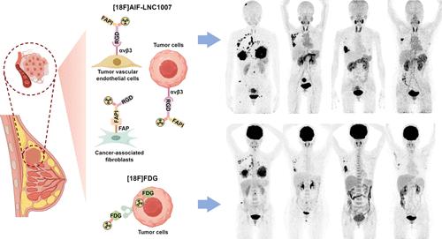 Comparative Study of [18F]AlF-LNC1007, [18F]FDG, and [18F]AlF-NOTA-FAPI-04 PET/CT in Breast Cancer Diagnosis: A Methodological Exploration and Analytical Insight