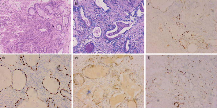 An elderly woman with acute respiratory failure and diffuse pulmonary changes.