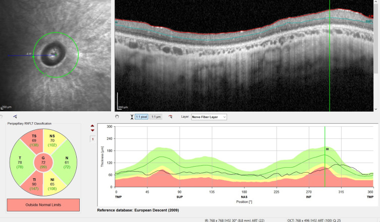 Peripapillary Retinal Nerve Fiber Layer (pRNFL) Thickness - A Novel Biomarker of Neurodegeneration in Late-Infantile CLN2 Disease.