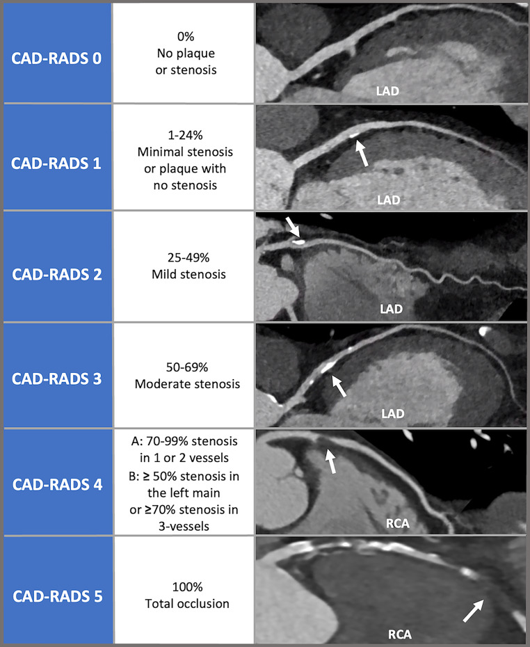 Moving towards a uniform diagnosis of coronary artery disease on coronary CTA : Coronary Artery Disease-Reporting and Data System 2.0.