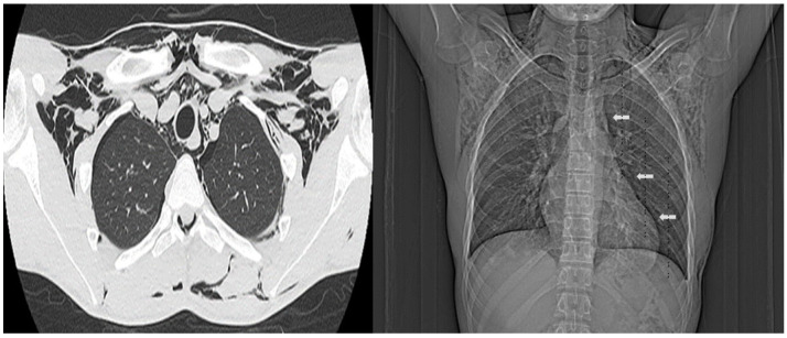 Hamman syndrome in an 18-year-old male patient.