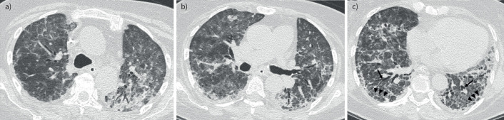 An elderly woman with acute respiratory failure and diffuse pulmonary changes.