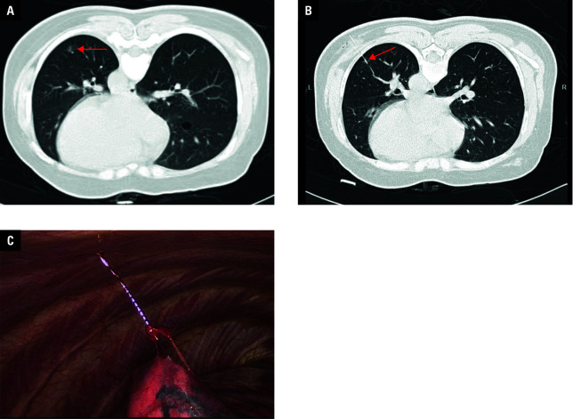 Preoperative computed tomography-guided localization of pulmonary ground‑glass nodules: a comparison of conventional and soft hook‑wires.