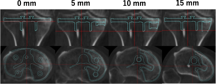 Are asymmetric designs of tibial components superior to their symmetric counterparts for constrained condylar total knee arthroplasty using metal block augmentation?