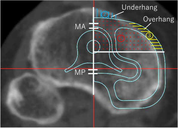 Are asymmetric designs of tibial components superior to their symmetric counterparts for constrained condylar total knee arthroplasty using metal block augmentation?