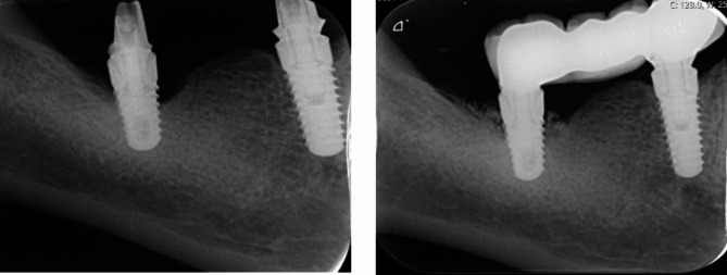 Reconstructive surgical treatment of peri-implantitis with use of a chitosan brush for decontamination- case series with 1-year follow-up.