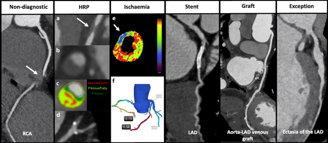 Moving towards a uniform diagnosis of coronary artery disease on coronary CTA : Coronary Artery Disease-Reporting and Data System 2.0.