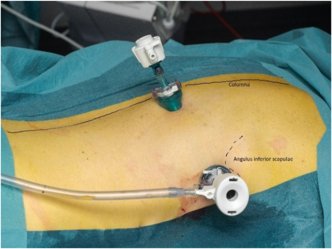 Pressurized IntraThoracic Aerosol Chemotherapy (PITAC) directed therapy of patients with malignant pleural effusion and pleural metastasis.
