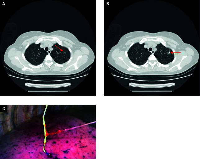 Preoperative computed tomography-guided localization of pulmonary ground‑glass nodules: a comparison of conventional and soft hook‑wires.