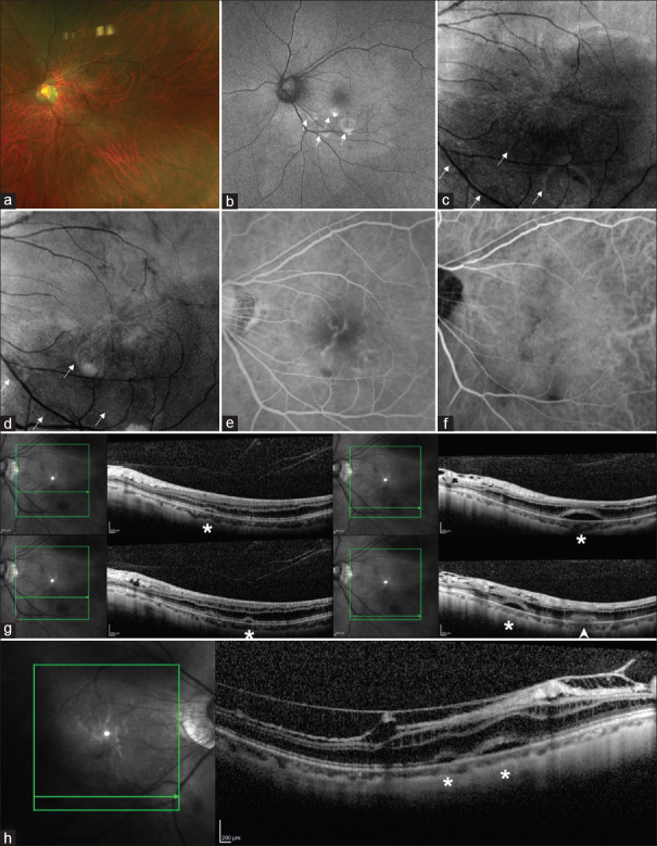 Multiple parafoveal retinal detachment in myopic tractional maculopathy.