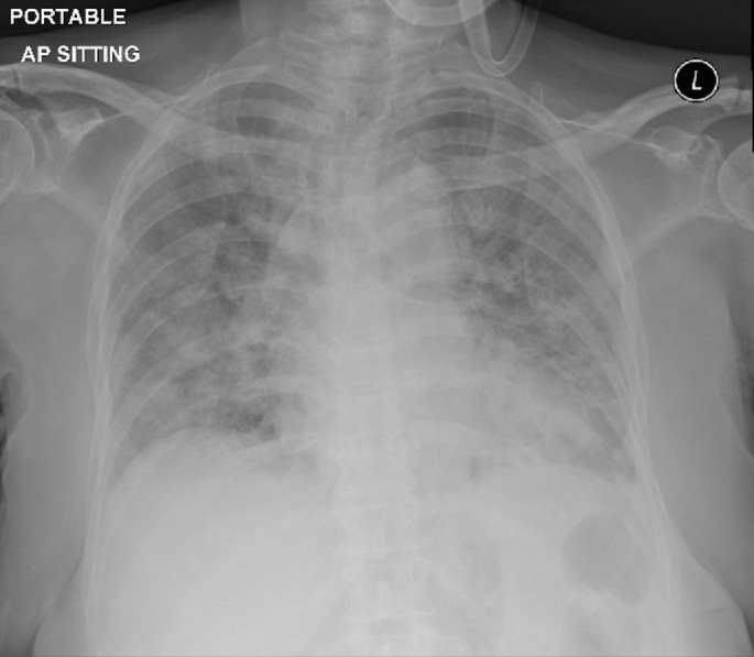 An elderly woman with acute respiratory failure and diffuse pulmonary changes.