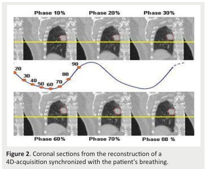 Lung stereotactic radiation therapy: Early results from the Salah Azaiez Institute.