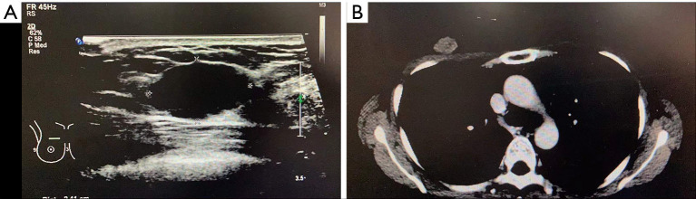 HER2 positive primary breast squamous cell carcinoma with good prognosis: a case report.
