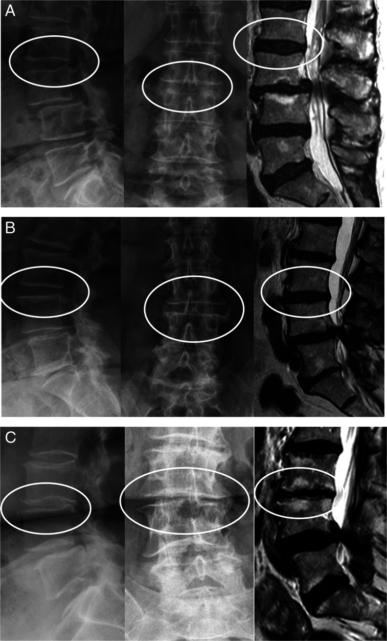 Nonlinear Effect of Preexisting Cranial Adjacent Disc Degeneration on Cumulative 12-Year Revision Risk Following Lumbar Fusions.