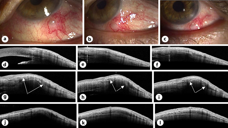 Conjunctival Phlyctenule and Nodular Scleritis in a Patient with Previous Herpes Simplex Virus-2 Exposure: Causative Agent or Innocent Bystander?