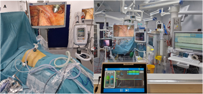 Pressurized IntraThoracic Aerosol Chemotherapy (PITAC) directed therapy of patients with malignant pleural effusion and pleural metastasis.