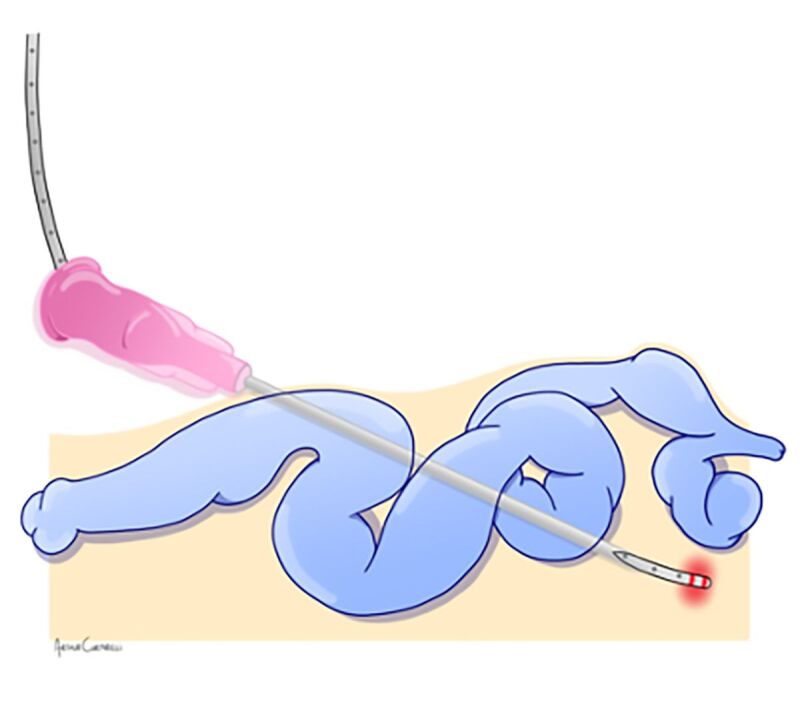 Treatment of the small saphenous vein and tributary veins with endolaser associated with ultrasound-guided foam in a patient with post-thrombotic syndrome: presenting the TEThA technique.