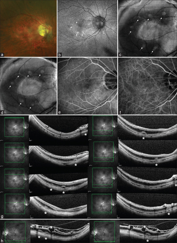 Multiple parafoveal retinal detachment in myopic tractional maculopathy.