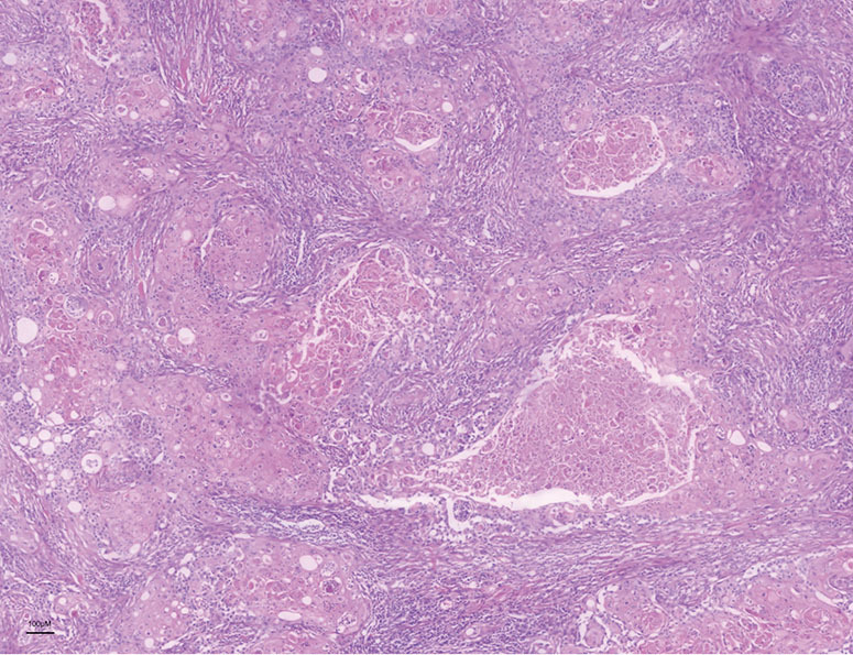 HER2 positive primary breast squamous cell carcinoma with good prognosis: a case report.