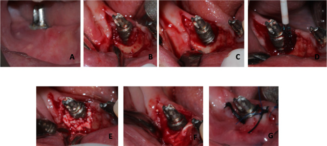 Reconstructive surgical treatment of peri-implantitis with use of a chitosan brush for decontamination- case series with 1-year follow-up.