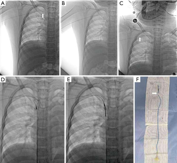 Fluoroscopy-guided guidewire-assisted technique for difficult removal of a peripherally inserted central venous catheter (PICC) in children: a report of three cases and literature review.