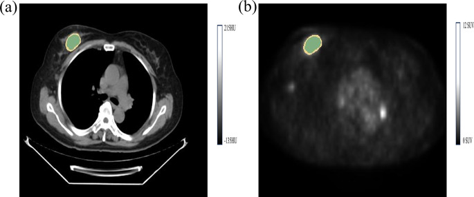 Intratumoral and peritumoral radiomics for preoperative prediction of neoadjuvant chemotherapy effect in breast cancer based on <sup>18</sup>F-FDG PET/CT.