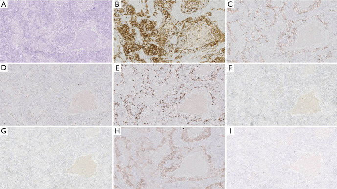 HER2 positive primary breast squamous cell carcinoma with good prognosis: a case report.