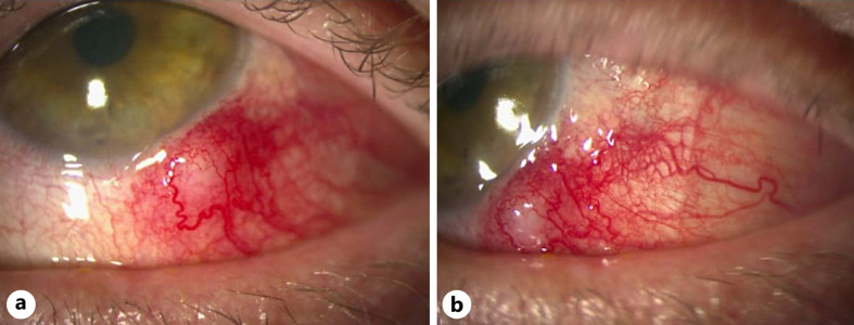 Conjunctival Phlyctenule and Nodular Scleritis in a Patient with Previous Herpes Simplex Virus-2 Exposure: Causative Agent or Innocent Bystander?