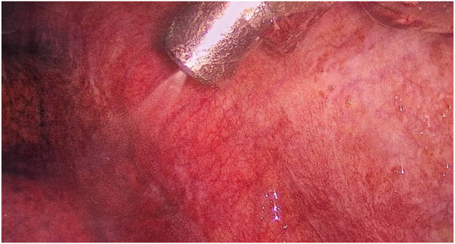 Pressurized IntraThoracic Aerosol Chemotherapy (PITAC) directed therapy of patients with malignant pleural effusion and pleural metastasis.