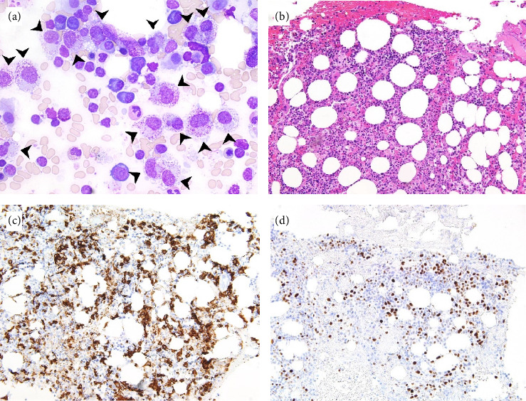 KIT V560D-Mutated Systemic Mastocytosis Associated With High-Risk Myelodysplastic Syndrome: A Unique Case of Systemic Mastocytosis-Associated Hematologic Neoplasm.