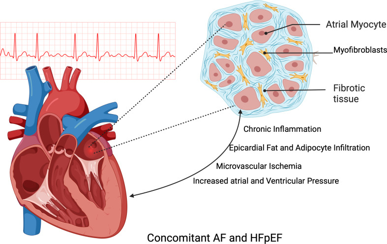 Atrial Fibrillation in Heart Failure: Novel Insights, Challenges, and Treatment Opportunities.