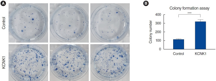 Exploring the Role of the KCNK1 Potassium Channel and Its Inhibition Using Quinidine in Treating Head and Neck Squamous Cell Carcinoma.
