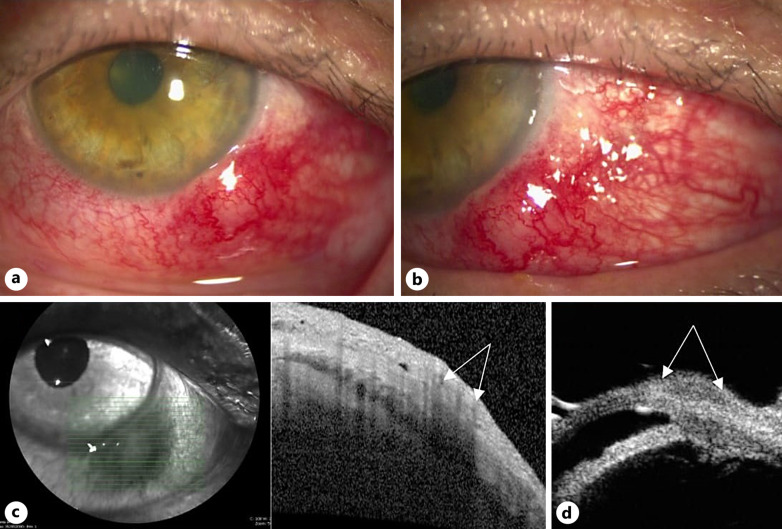 Conjunctival Phlyctenule and Nodular Scleritis in a Patient with Previous Herpes Simplex Virus-2 Exposure: Causative Agent or Innocent Bystander?