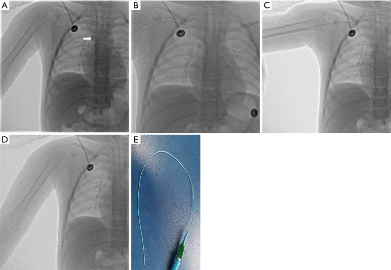 Fluoroscopy-guided guidewire-assisted technique for difficult removal of a peripherally inserted central venous catheter (PICC) in children: a report of three cases and literature review.