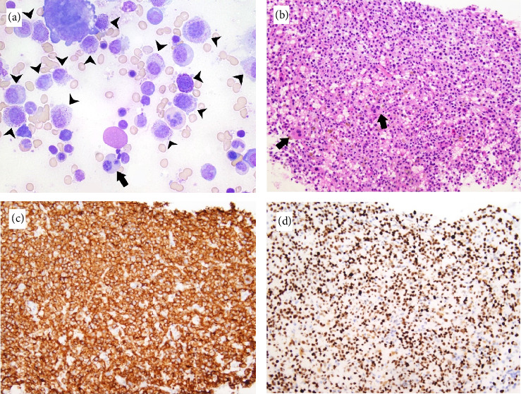 KIT V560D-Mutated Systemic Mastocytosis Associated With High-Risk Myelodysplastic Syndrome: A Unique Case of Systemic Mastocytosis-Associated Hematologic Neoplasm.