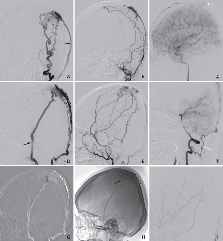 Endovascular Treatment of Scalp Arteriovenous Fistula: Transvenous Onyx Embolization with Balloon Occlusion.