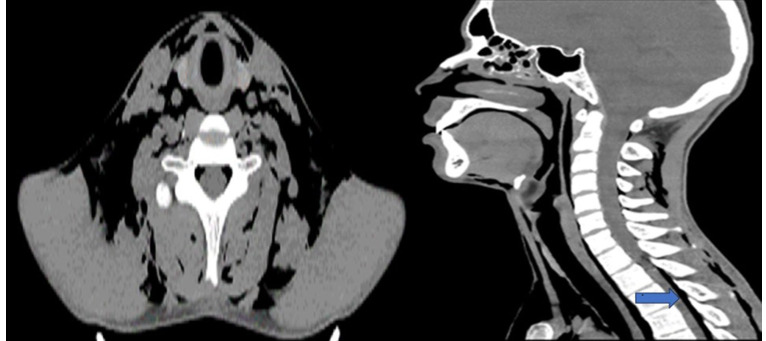 Hamman syndrome in an 18-year-old male patient.