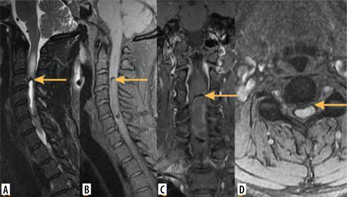 Imaging of intramedullary tumours of the spinal cord.
