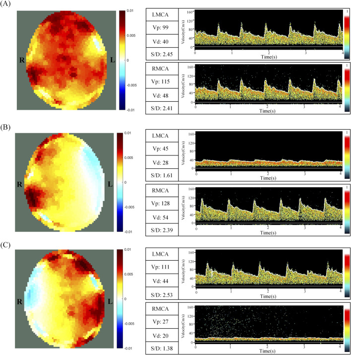 Evaluation of cerebral perfusion heterogeneity by the electrical impedance tomography.