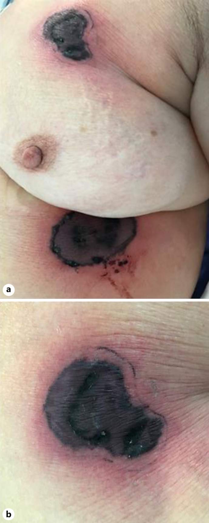 Ecthyma Gangrenosum of Fungal Origin: A Case Report.