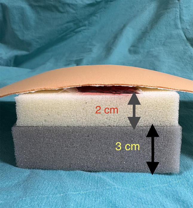 Comparison of bougie-guided cricothyrotomy and traditional cricothyrotomy techniques in an obese 3D-printed surgical airway manikin: a randomized controlled study.