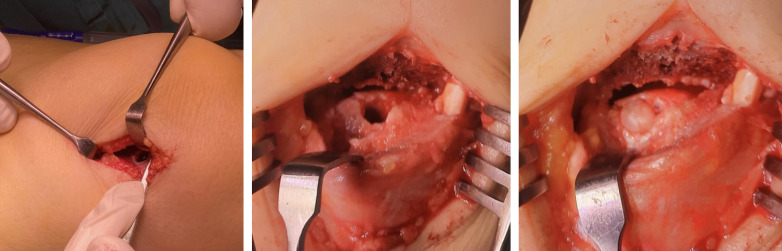 Comparison of autologous matrix-induced chondrogenesis and mosaicplasty in the treatment of osteochondral defects of the talus.